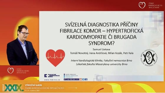 video: SVZELN DIAGNOSTIKA PINY FIBRILACE KOMOR  HYPERTROFICK KARDIOMYOPATIE I BRUGADA SYNDROM?