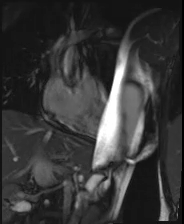 file_5e6a0a5aea913_110_video16_MRI-RVOT1.mp4.mp4