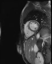 file_5e6a0a609b81c_110_video23_MRI-SAX5.mp4.mp4