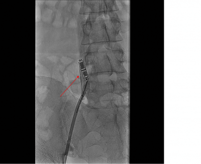 Obr. 3  Extrakce leadless kardiostimultoru s pouitm explantan kliky (erven ipka)
