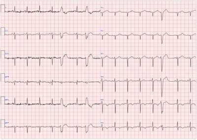 Obr. 1  EKG pacienta pi prvnm pjmu na nae pracovit. Jsou patrn negativn T v II, aVF, V5 a V6.