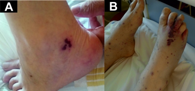 Obr. 4  Kon nekrza u vaskulitick fze eozinofiln granulomatzy s polyangitiidou.
