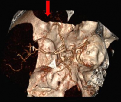 Obr. 2 � CTAG s pr�kazem okluze periferie ACA vlevo