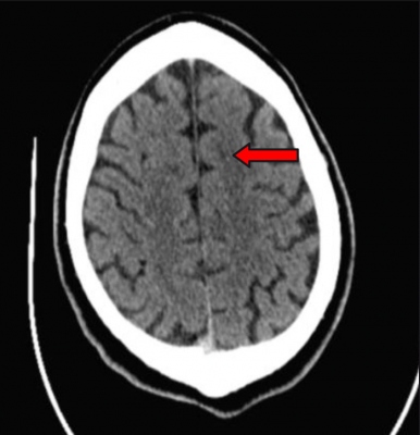 Obr. 3 � CT s n�lezem postischemick�ch zm�n F parasagit�ln� sin.