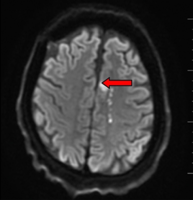 Obr. 4 � Obdobn� n�lez na MR-DWI sekvenc�ch