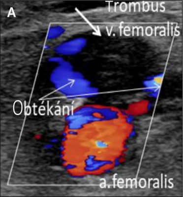 Obr. 3 � (A) Bedside duplexn� sonografie s barevn�m mapov�n�m � velk� mobiln� trombus v levostrann� femor�ln� ��le se zn�mkami obt�k�n� (�ipka).