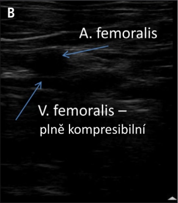 Obr. 3 � (B) Duplexn� vy�et�en� prav� doln� kon�etiny.