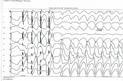 Obr. 2 � Programovan� stimulace komor s indukc� monomorfn� komorov� tachykardie tvaru blok�dy prav�ho Tawarova ram�nka �ty�mi extrastimuly