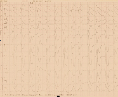Obr. 1 � Polymorfn� komorov� tachykardie zachycen� na 12svodov�m EKG v oblastn� nemocnici kr�tce po �sp�n� kardiopulmon�ln� resuscitaci a obnov� ob�hu