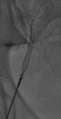 Obr. 4  Extrakce bioptomem