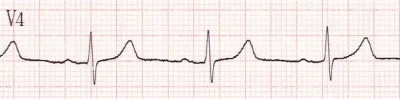 Obr. 7 – EKG při propuštění