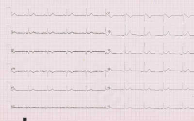 Obr. 2 – Typ 1 brugadovského EKG: alespoň 2mm elevace bodu J ve svodu V1 s navazujícím descendentním úsekem ST přecházejícím do negativní vlny T