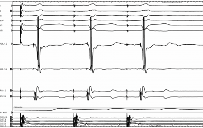 Obr. 5 – Elektrofyziologické vyšetření: I, II, III, aVF, V1 a V6 jsou svody povrchového EKG; ABL 1,2 distální tip ablačního katétru, ABL 3,4 proximální póly ablačního katétru; RV 1,2 a RV 3,4 katétr v pravé komoře srdeční; CS 1–10 katétr v koronárním sinu. P1 ART je křivka přímého měření krevního tlaku. V ABL 1,2 je před komplexem QRS patrný signál akcesorní spojky.