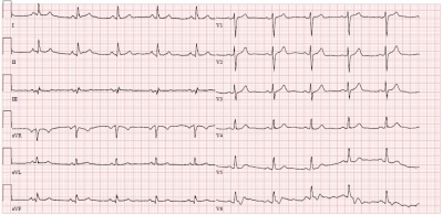 Obr. 2 – Klidové EKG