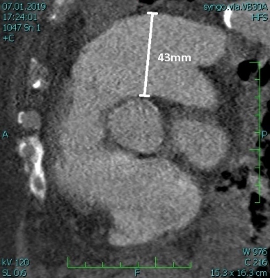 Obr.1 – (B) CT angiografie s průkazem dilatace plicnice, sagitální řez