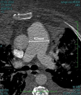 Obr.1 – (A) CT angiografie s průkazem dilatace kmene plicnice, transverzální řez