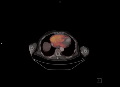file_5db09b7513008_108_Kazuistika_Madron_Video_4_-_PET-CT_-_pred_zahajenim_lecby.mp4.mp4