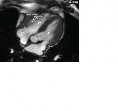 Obr. 3  Magnetick rezonance srdce, tydutinov projekce  zeteln regrese tumoru po dokonenm 3. cyklu chemoterapie. Ao  aorta; LK  lev komora; LS  lev s; PK  prav komora; PS  prav s. 