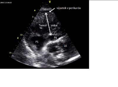 Obr. 1.  Echokardiogram srdce, subxifoideln projekce  patrn tumorzn infiltrace stny prav sn a prav komory. LK  lev komora; LS  lev s; PK  prav komora; PS  prav s. 