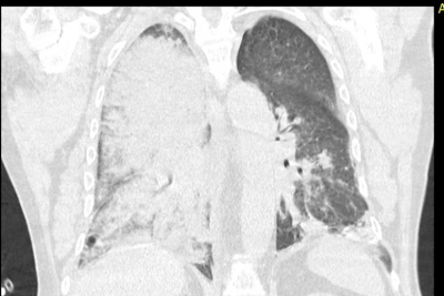 Obr. 3  CT hrudnku