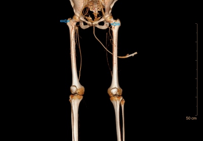 Obr. 3  CT angiografie tepennho eit dolnch konetin, vstupn vyeten. Vpravo uzvr arteria femoralis communis zasahujc do bifurkace, vlevo uzvr arteria iliaca interna i externa, del uzvr arteria femoralis communis, pesahujc na arteria femoralis superficialis i na arteria femoralis profunda (oznaeno modrmi ipkami).