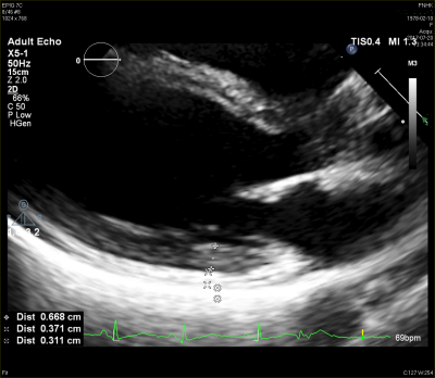 Obr. 3  Echokardiogram, parasternln dlouh osa  denzn perikard v oblasti zadn stny lev komory. Nelze s jistotou urit, zda se jedn o nhodn nespecifick nlez i o projev nemoci zjevn na magnetick rezonanci.