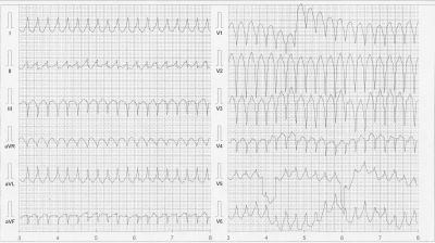 Obr. 1  Vstupn EKG s monomorfn komorovou tachykardi s morfologi LBBB