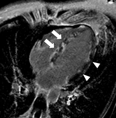 Fig. 1 –Magnetic resonance imaging: T1 PSIR sequence, four-chamber view image. Non-homogenous distribution of late gadolinium enhancement with the maximum at the interventricular septum (arrows), discreetly also at the lateral wall (arrow heads).