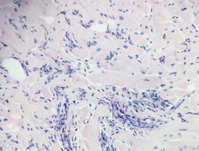Fig. 2 – Eosinophilic infiltrate of the myocardial interstitium.