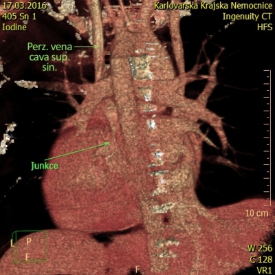 Obr. 2 – CT venografie s 3D rekonstrukcí. Perzistující venacava superior sinistra ústí přes ostium do koronárního sinu.