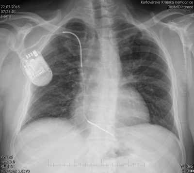 Obr. 4 – Skiagram po implantaci ICD zprava. Defibrilační elektroda je umístěna do hrotu pravé komory.
