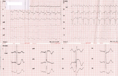 Obr. 1 – EKG natočené v ZZS Moravskoslezského kraje, vidíme sinusovou tachykardii s normálními převodovými časy a obrazem elevací úseku ST ve V1, V2 a depresí úseku ST ve svodech II, III, aVF, V4–V6 (dole posun 50 mm/s, amplituda 0,5 mV).