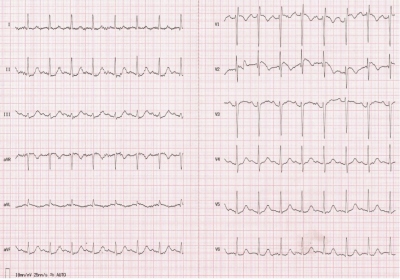 Obr. 3 – EKG natočené na emergentním příjmu, trvá sinusová tachykardie s poklesem elevací úseku ST ve V1–V2, zmírněním depresí úseku ST ve II, III, aVF a V4–V6.