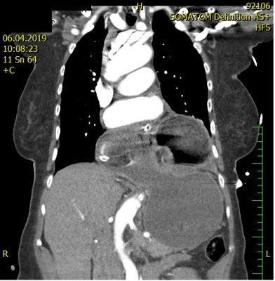 Obr. 4 – CT hrudníku a břicha, kde vidíme objemnou smíšenou brániční hernii charakteru „upside-downstomach“, antropylorus a fundus je nad bránicí, pod bránicí zbylá část těla žaludku, ve fundu vidíme zavedenou NGS sondu, antropylorus je blíže hrudní stěně vlevo.