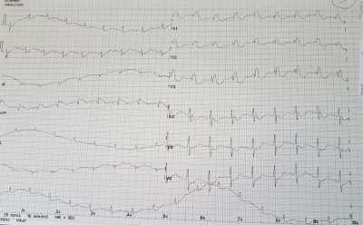Obr. 2 – Vstupní EKG křivka při příjmu na JIP