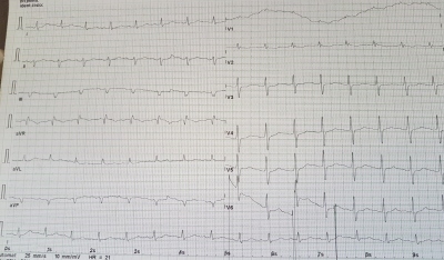 Obr. 5 – EKG křivka 24 h po přijetí na JIP, 24 h po podání trombolytické terapie