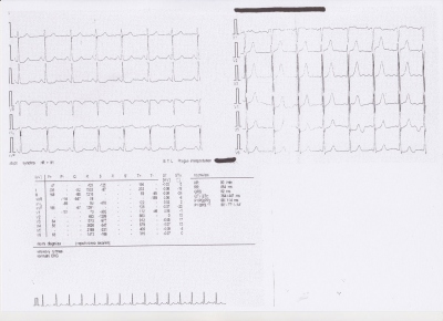 Obr. 1  EKG kivka pi vstupnm vyeten