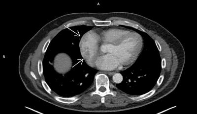 Obr. 3  PET/CT vyeten (transverzln a frontln projekce) prokazuje hypermetabolismus glukzy (= zven metabolick aktivita), kter se promt do nepravidelnch tvar prominujcch ze stny prav sn intraluminln (ipky). Pozn.: difuzn zven metabolick aktivita se asto fyziologicky zobrazuje v myokardu lev komory srden (co je patrn i u tohoto pacienta), tenk myokard pravostrannch srdench oddl fyziologicky m mt nzkou metabolickou aktivitu. Snmky laskav poskytlo Oddlen nuklern medicny  PET centrum Nemocnice Na Homolce