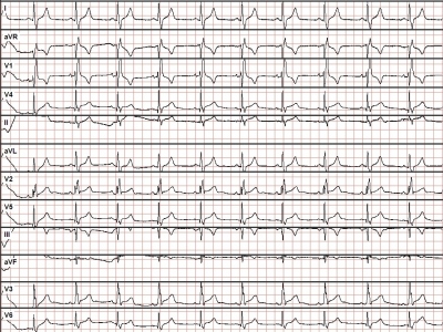Obr. 1  Vstupn EKG