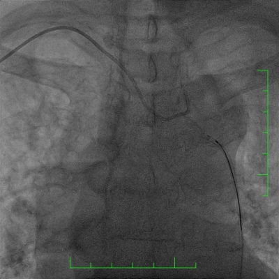 Obr. 4  Vysmeknut konce diagnostickho kattru v aortlnm oblouku