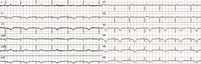 Obr. 1 – EKG s inverzí vln T ve svodech V1–V6, II, III, aVF a prodloužený interval QT
