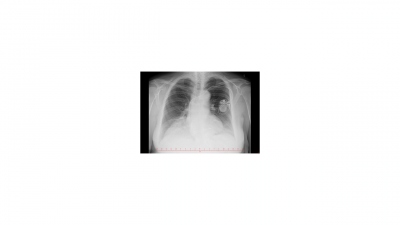 Obr. 2  Pacientce byl implantovn trval dvoudutinov kardiostimultor.