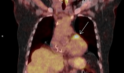 Obr. 3 A  PET/CT myokardu a plic (A, B, C, D), petrvvajc okrsek vy metabolick aktivity (ipka) v oblasti bazln poloviny pedn stny lev komory. Laskav zapjila MUDr. M. Jarkov, ONM  PET centrum, Nemocnice Na Homolce.