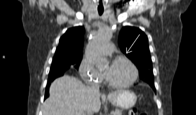 Obr. 3 B  PET/CT myokardu a plic (A, B, C, D), petrvvajc okrsek vy metabolick aktivity (ipka) v oblasti bazln poloviny pedn stny lev komory. Laskav zapjila MUDr. M. Jarkov, ONM  PET centrum, Nemocnice Na Homolce.