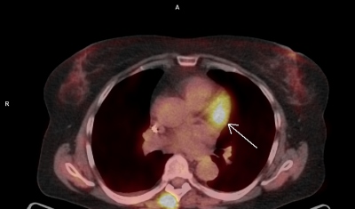Obr. 3 C  PET/CT myokardu a plic (A, B, C, D), petrvvajc okrsek vy metabolick aktivity (ipka) v oblasti bazln poloviny pedn stny lev komory. Laskav zapjila MUDr. M. Jarkov, ONM  PET centrum, Nemocnice Na Homolce.