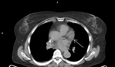 Obr. 3 D  PET/CT myokardu a plic (A, B, C, D), petrvvajc okrsek vy metabolick aktivity (ipka) v oblasti bazln poloviny pedn stny lev komory. Laskav zapjila MUDr. M. Jarkov, ONM  PET centrum, Nemocnice Na Homolce.