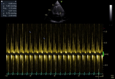 Obr. 1  Echokardiografie: Pulsn dopplerovsk analza prtoku mitrln chlopn. Ptomna respiran variabilita prtoku o 30 %. 