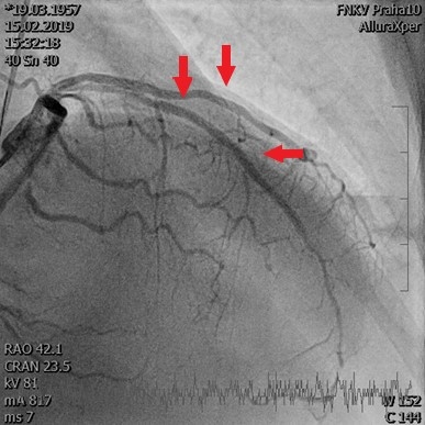 Obr. 2  (B) Koronarografick nlez po primrn PCI culprit lze na RIA, dle oetena tak vznamn stenza na RIM, ipkami oznaeny msta implantovanch stent. PCI  perkutnn koronrn intervence; RIA  ramus interventricularis anterior; RIM  ramus intermedius.