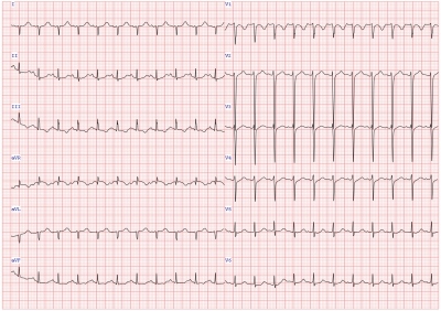 Obr. 1  EKG se sinusovou tachykardi a vertiklnm sklonem srden osy