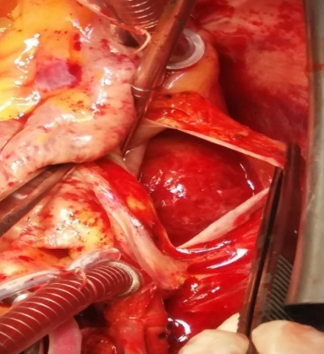 Fig. 1 – Intraoperative finding. After incision of the left atrium, a smooth round thrombus was visualised.